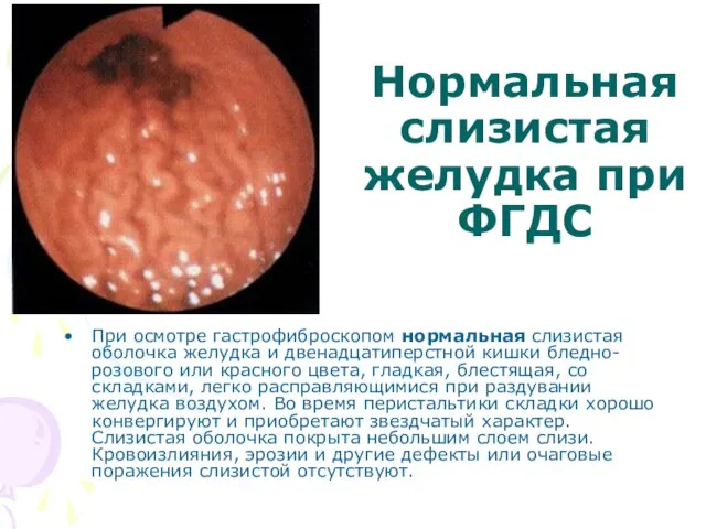 Нормальная слизистая желудка при ФГДС При осмотре гастрофиброскопом нормальная слизистая оболочка