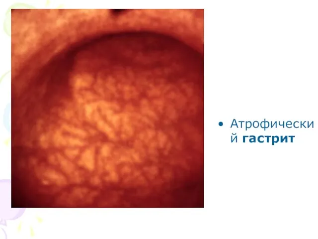 Атрофический гастрит