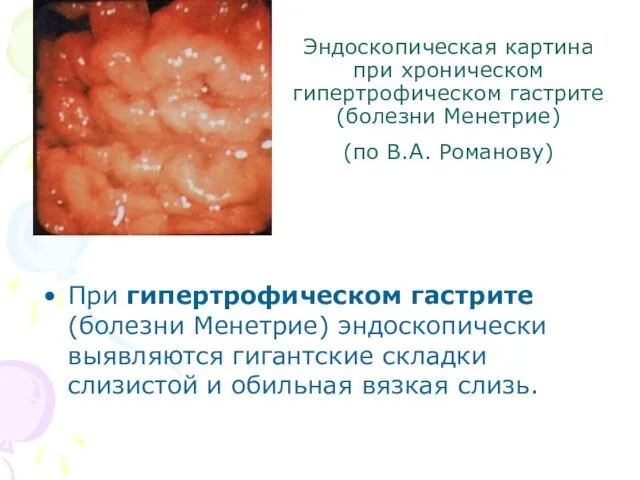 Эндоскопическая картина при хроническом гипертрофическом гастрите (болезни Менетрие) (по В.А. Романову)