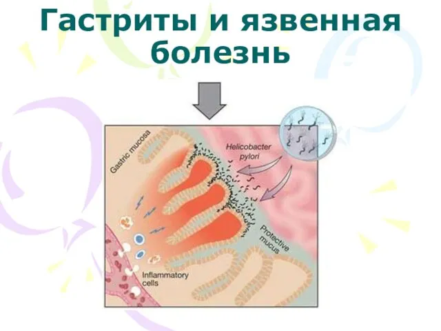 Гастриты и язвенная болезнь