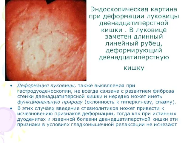 Эндоскопическая картина при деформации луковицы двенадцатиперстной кишки . В луковице заметен