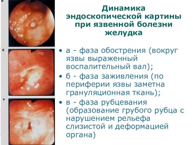 Динамика эндоскопической картины при язвенной болезни желудка а - фаза обострения