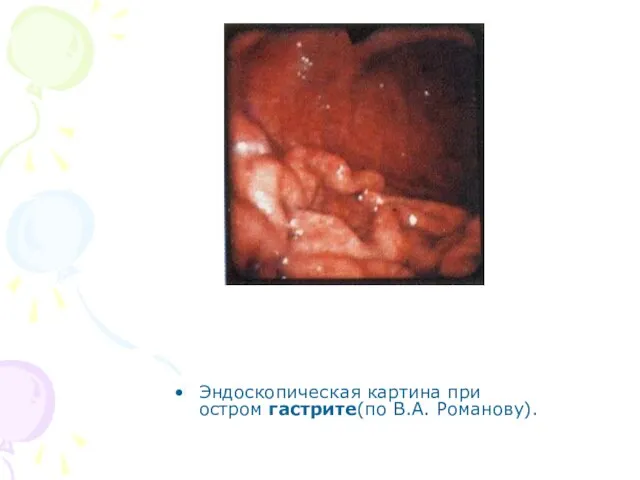 Эндоскопическая картина при остром гастрите(по В.А. Романову).
