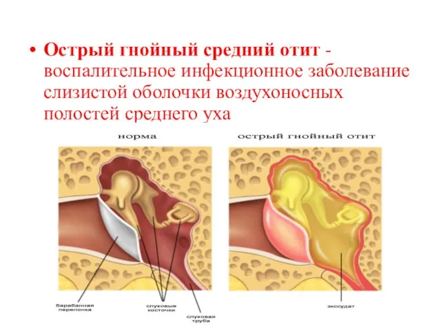 Острый гнойный средний отит - воспалительное инфекционное заболевание слизистой оболочки воздухоносных полостей среднего уха