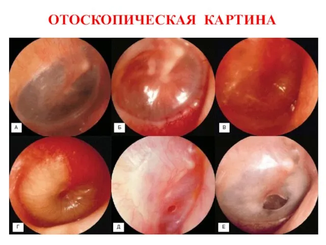 ОТОСКОПИЧЕСКАЯ КАРТИНА