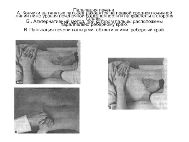 Пальпация печени. А. Кончики вытянутых пальцев находятся на правой среднеключичной линии