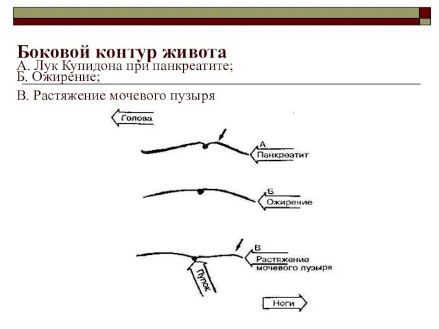 Боковой контур живота А. Лук Купидона при панкреатите; Б. Ожирение; В. Растяжение мочевого пузыря