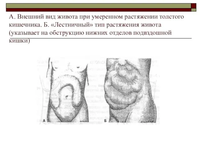 А. Внешний вид живота при умеренном растяжении толстого кишечника. Б. «Лестничный»