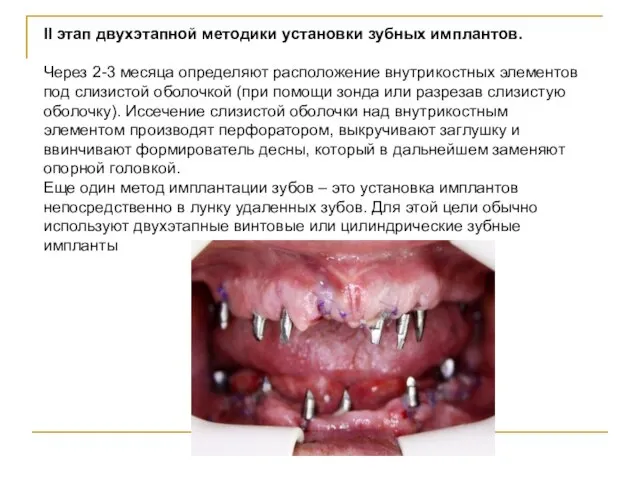 II этап двухэтапной методики установки зубных имплантов. Через 2-3 месяца определяют