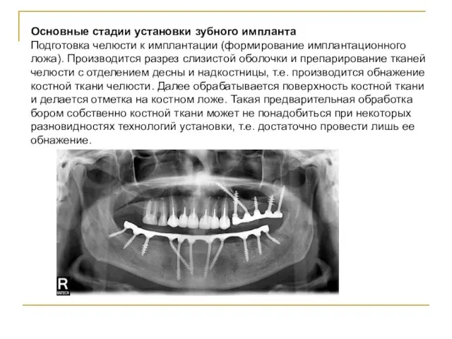 Основные стадии установки зубного импланта Подготовка челюсти к имплантации (формирование имплантационного