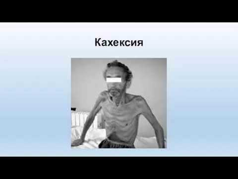 Кахексия