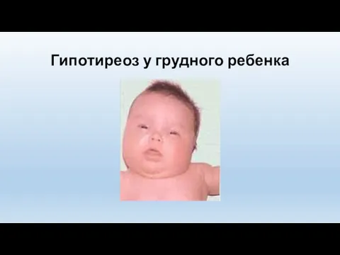 Гипотиреоз у грудного ребенка