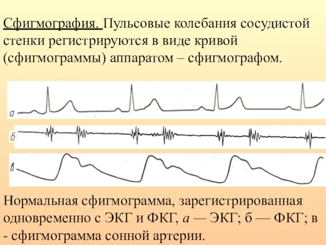 Сфигмография. Пульсовые колебания сосудистой стенки регистрируются в виде кривой (сфигмограммы) аппаратом