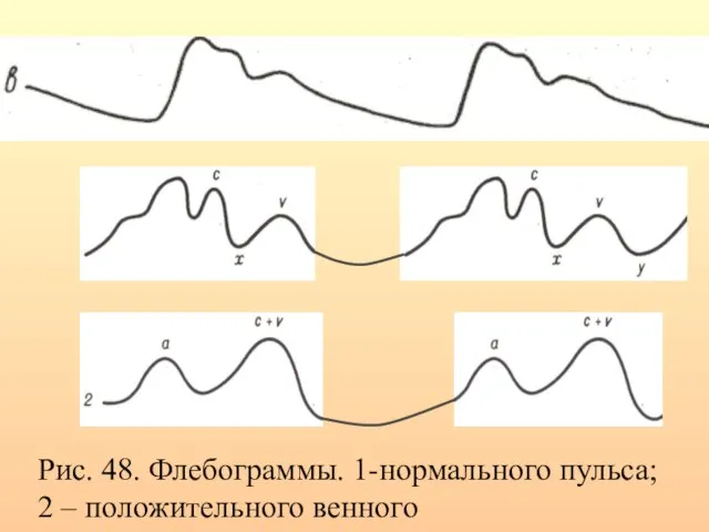 Рис. 48. Флебограммы. 1-нормального пульса; 2 – положительного венного