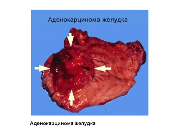Аденокарцинома желудка