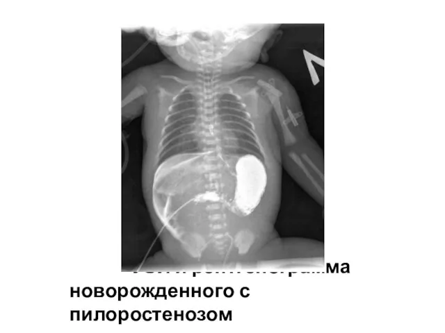 УЗИ и рентгенограмма новорожденного с пилоростенозом
