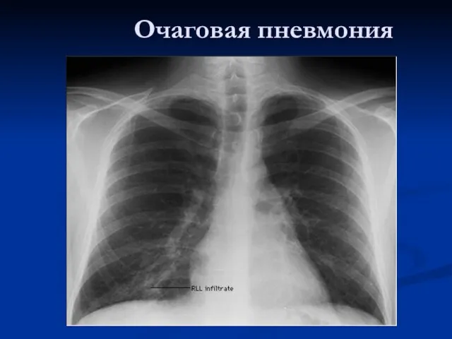 Очаговая пневмония