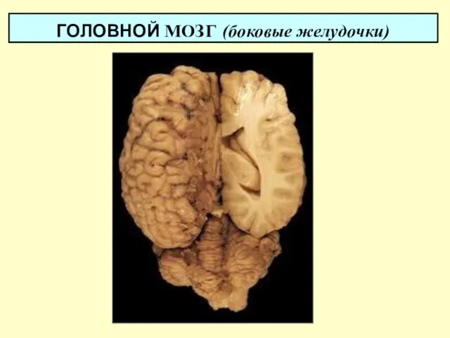 ГОЛОВНОЙ МОЗГ (боковые желудочки)