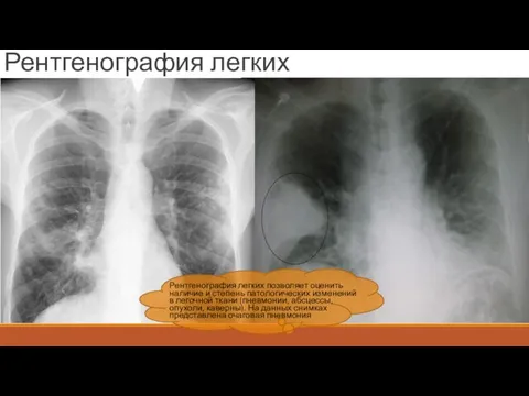 Рентгенография легких Рентгенография легких позволяет оценить наличие и степень патологических изменений