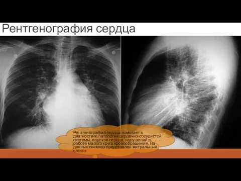 Рентгенография сердца Рентгенография сердца помогает в диагностике патологий сердечно-сосудистой системы, пороков