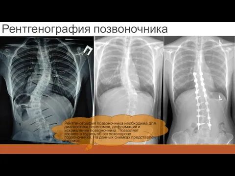 Рентгенография позвоночника Рентгенография позвоночника необходима для диагностики переломов, деформаций и искривлений