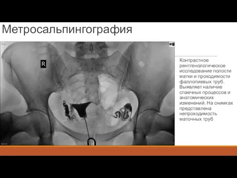 Метросальпингография Контрастное рентгенологическое исследование полости матки и проходимости фаллопиевых труб. Выявляет