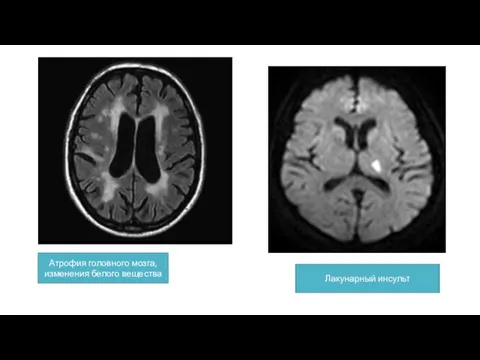 Атрофия головного мозга, изменения белого вещества Лакунарный инсульт