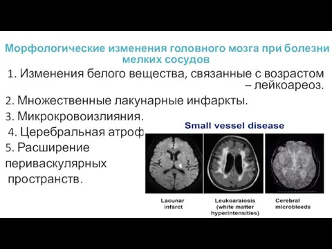 Морфологические изменения головного мозга при болезни мелких сосудов 1. Изменения белого