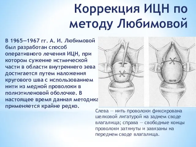 В 1965—1967 гг. А. И. Любимовой был раз­работан способ оперативного лечения