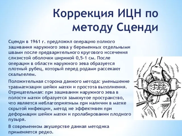 Коррекция ИЦН по методу Сценди Сценди в 1961 г. предложил операцию