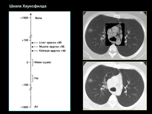 Шкала Хаунсфилда