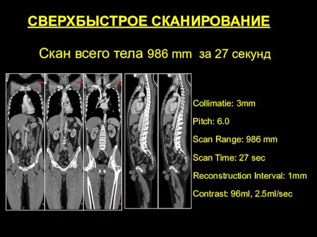 Скан всего тела 986 mm за 27 секунд Collimatie: 3mm Pitch: