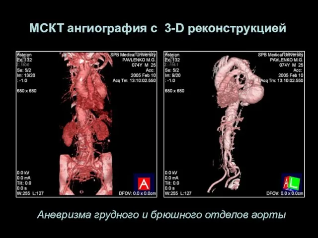 Аневризма грудного и брюшного отделов аорты МСКТ ангиография с 3-D реконструкцией