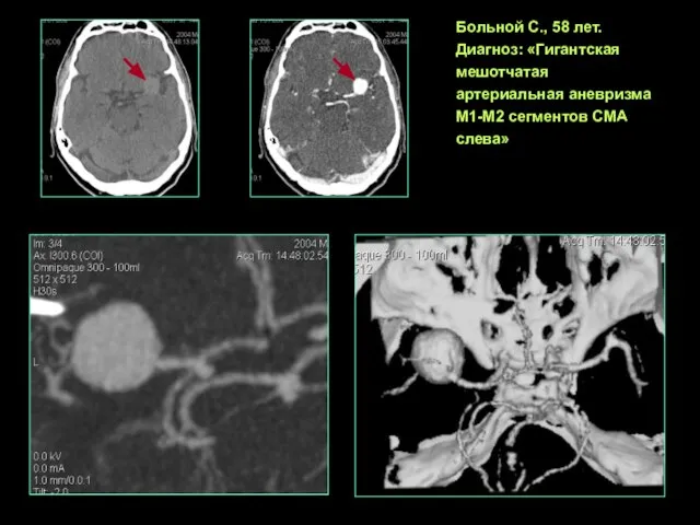 Больной С., 58 лет. Диагноз: «Гигантская мешотчатая артериальная аневризма М1-М2 сегментов СМА слева»
