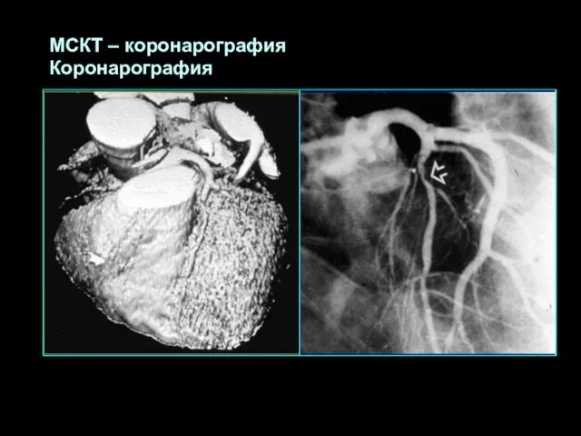 МСКТ – коронарография Коронарография