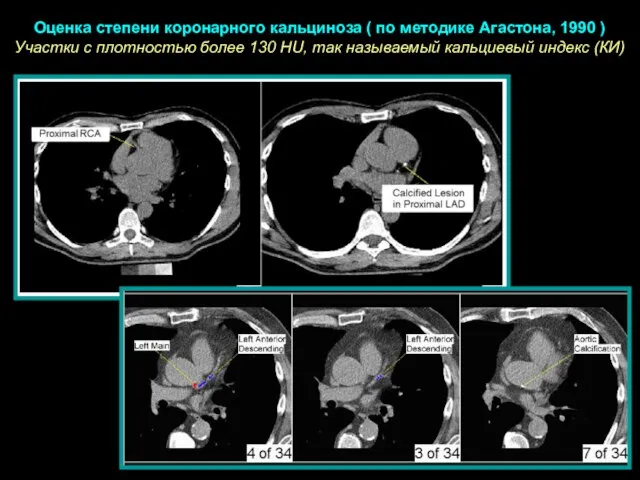 Оценка степени коронарного кальциноза ( по методике Агастона, 1990 ) Участки