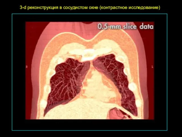 3-d реконструкция в сосудистом окне (контрастное исследование)