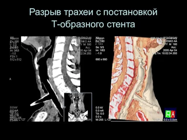 Разрыв трахеи с постановкой Т-образного стента