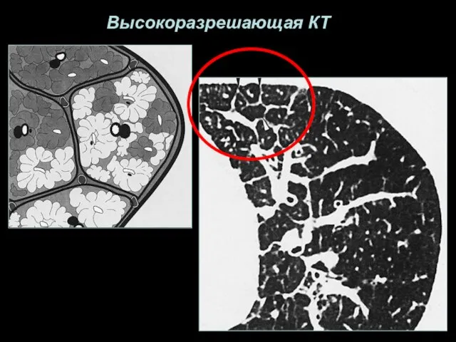 Высокоразрешающая КТ