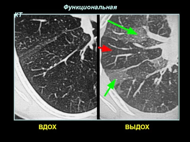 ВДОХ ВЫДОХ Функциональная КТ