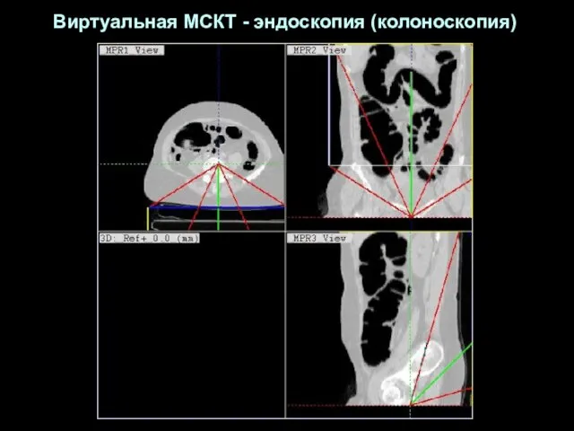 Виртуальная МСКТ - эндоскопия (колоноскопия)