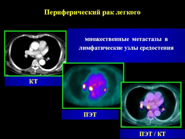 ПЭТ КТ ПЭТ / КТ множественные метастазы в лимфатические узлы средостения Периферический рак легкого