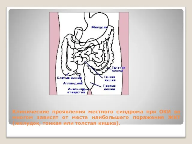 Клинические проявления местного синдрома при ОКИ во многом зависят от места