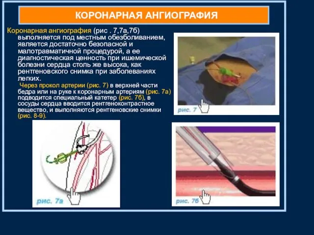 КОРОНАРНАЯ АНГИОГРАФИЯ Коронарная ангиография (рис . 7,7а,7б) выполняется под местным обезболиванием,