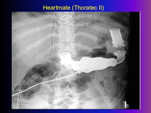 Heartmate (Thoratec II)