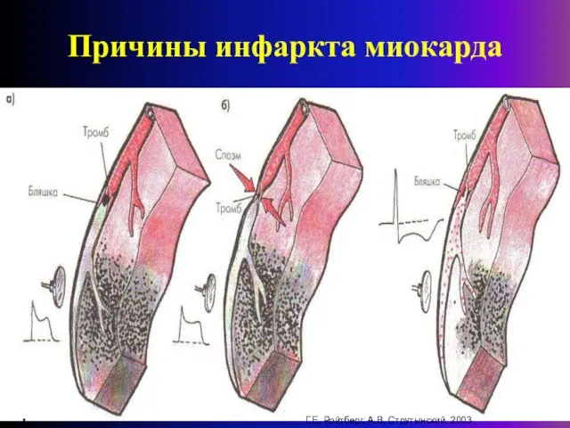 Причины инфаркта миокарда Г.Е. Ройтберг, А.В. Струтынский. 2003