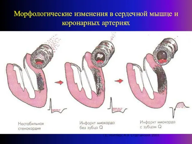 Морфологические изменения в сердечной мышце и коронарных артериях Г.Е. Ройтберг, А.В. Струтынский. 2003.