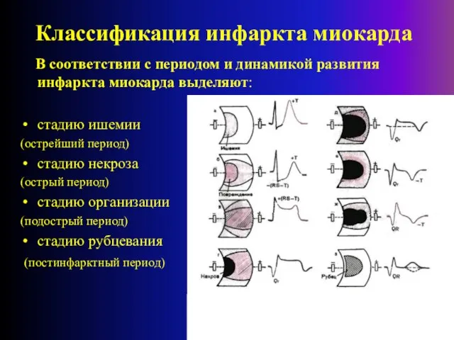 Классификация инфаркта миокарда В соответствии с периодом и динамикой развития инфаркта