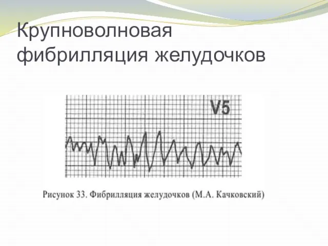 Крупноволновая фибрилляция желудочков