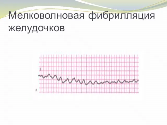 Мелковолновая фибрилляция желудочков